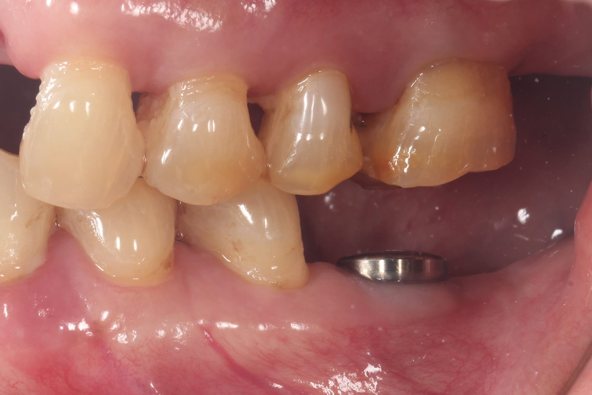 Dental Implants