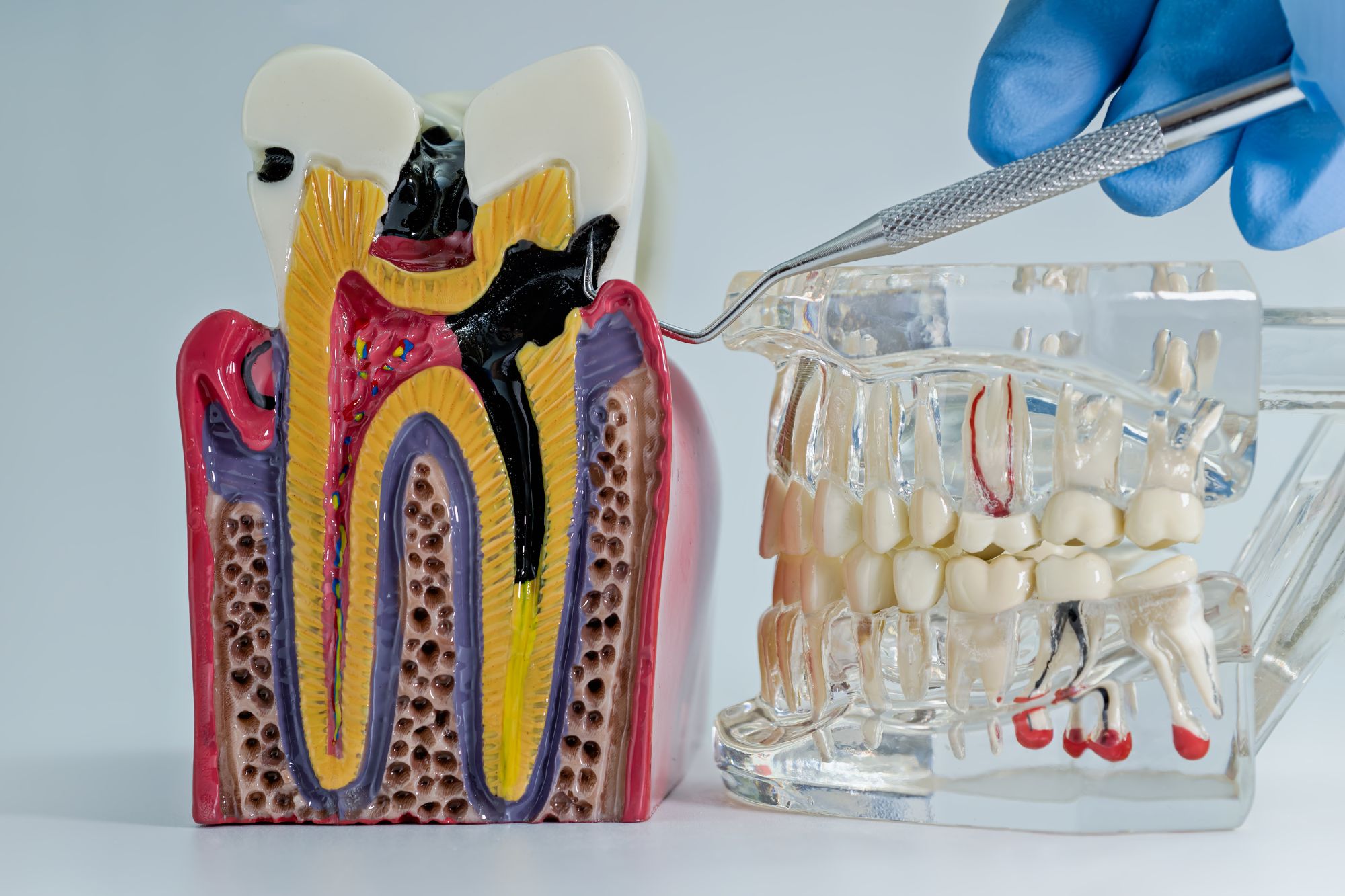 Root Canal Treatment