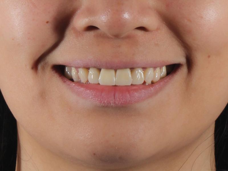 SMILE-makeover-after-enhanced-smile-aesthetic-kl-selangor